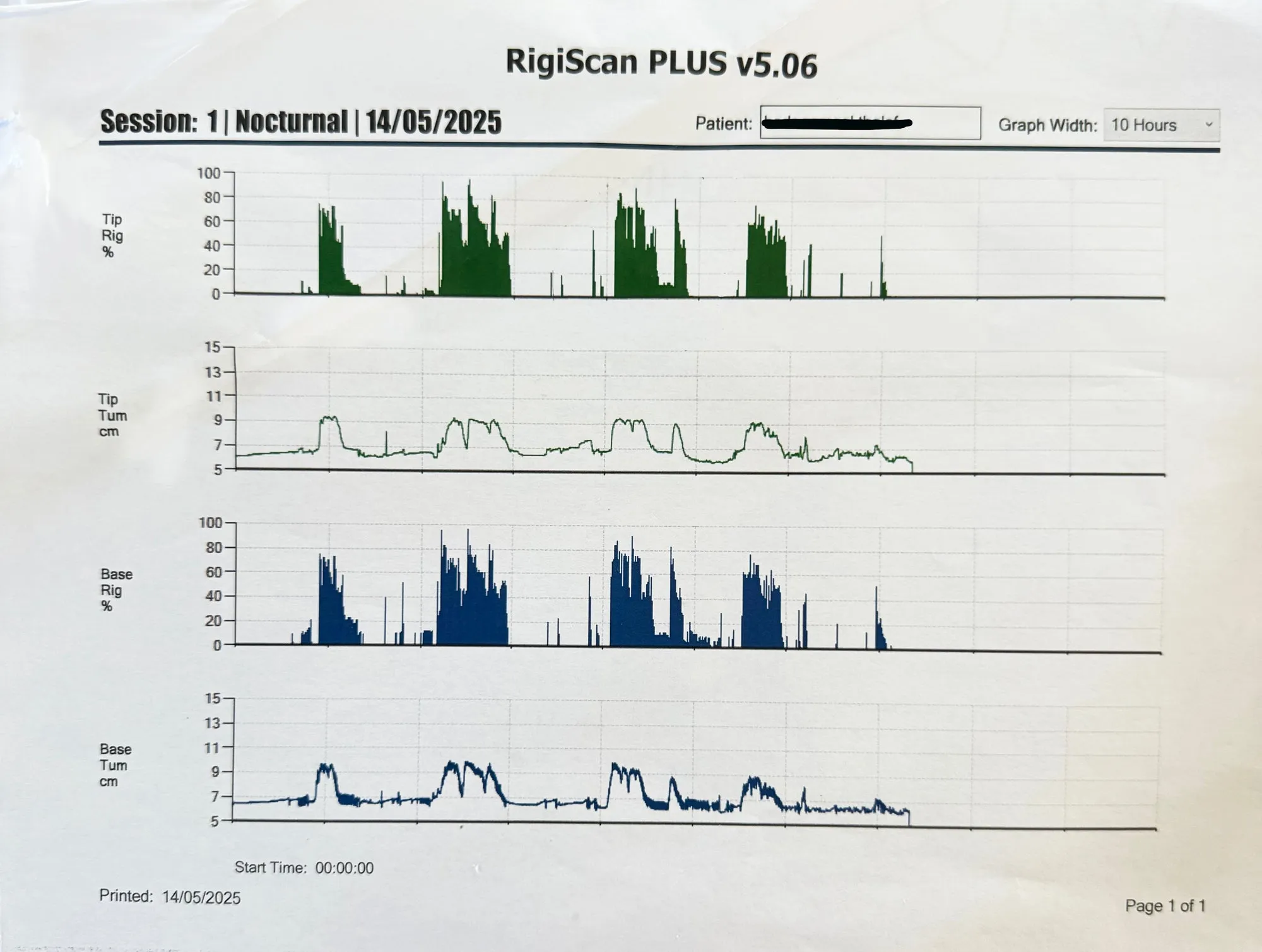 A RigiScan Plus nocturnal session printout showing tip and base rigidity and tumescence traces across ten hours